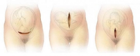 Кесарево сечение: за и против