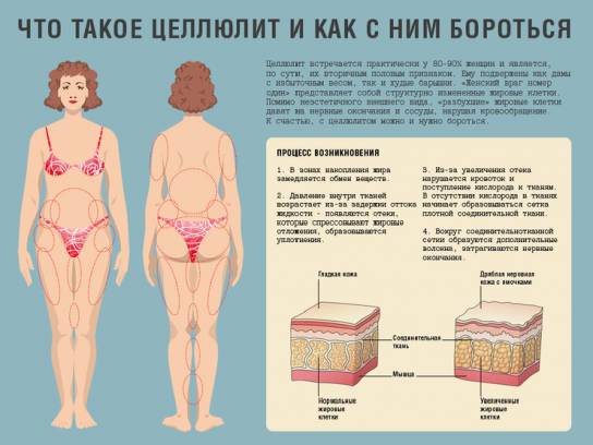 Почему появляется целлюлит?