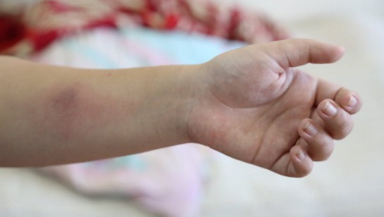 Почему увеличено Манту?