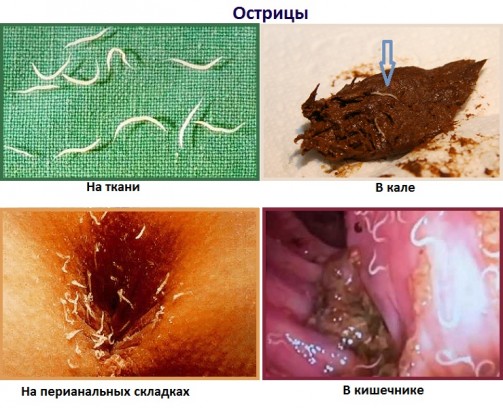Другие признаки глистной инвазии