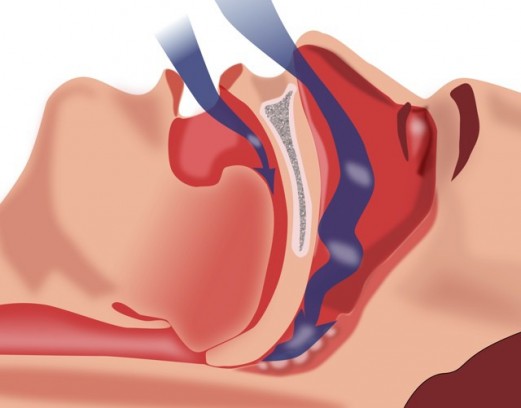 Распространённые причины женского храпа