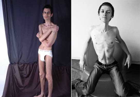 Джереми Гиллитцера - самый худой мужчина в мире!