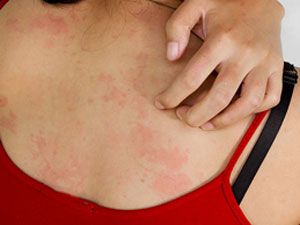 Аллергия на коже