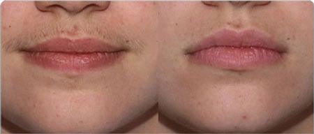 Результат удаления волос