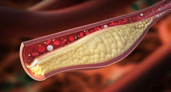 Сосуд с жировыми отложениями